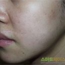 스마트페이스한의원 | [스마트페이스한의원후기] 민감성여드름치료로 연기를 할수있게되었어요~