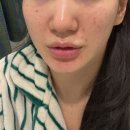 하이스킨 - 사하구 | [동교동피부과] 스킨부스터 리쥬하이 솔직후기와 통증, 효과 및 주의사항