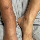 김포다조은병원 | 발목 골절 수술 잘하는곳 - 김포다조은병원/골절에 좋은음식