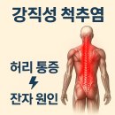 강직성 척추염, 척추가 굳어지는 만성 염증 질환의 이해!! 이미지