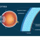 아이디어구미2번가 | 초고도근시안경 ICL (렌즈삽입술)제거 수술 후 안경 &amp; 수술 시 주의사항 by 구미아이디어안경원 윤선생네