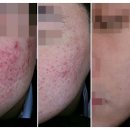 동탄원천로 1R(기점->1) | [공지] 동탄여드름흉터 피부과 방문 전 필독