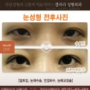 갤러리성형외과의원 Daum카페