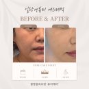 두피클린&퓨어왁싱 | 평택 에스테틱 일랑엔뷰티에서 물방울리프팅 '퓨어케어' 받고 기미·피부 되살렸어요