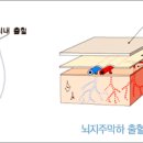 뇌실내출혈 (intraventricular hemorrhage, IVH) 이미지