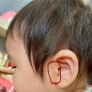 경희의료원 | 아기 스킨텍수술 후기 경희의료원 범진식교수님