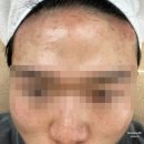 청주슈가링 남자 풀페이스 왁싱 후기｜온리제이
