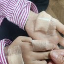 새봄외과의원 | [일산 새봄외과의원 화상전문클리닉]달고나 만들다가 손에 화상ㅜㅜ