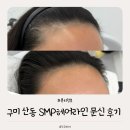 구미헤어라인문신 “다움”ㅣ여성탈모 M자이마 후기