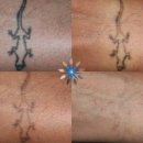 파장 | 문신 제거 레이저 비용 후기: 색깔별 최적 파장과 전후 사진 공유