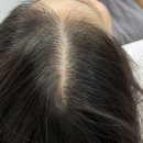 무수(MOOSOO) | 강남smp 시술 추천 무수 청담 : 자연스러운 두피문신엔 무수 청담 방문 및 시술 후기