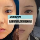 식스타 | 얼굴살빼는법에 목숨건 식스타의 인모드fx 얼굴지방분해주사 후기|압구정|