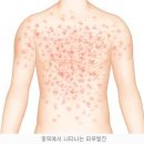 홍역 (measles) 이미지