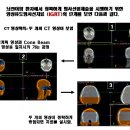 Cone beam CT 를 이용한 영상유도방사선치료 이미지