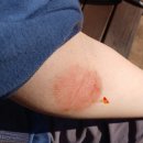 자작나무한의원 | [화폐상습진] 투병 완치 후기 3편 (Feat. 한포진)