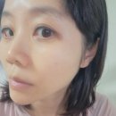브이아이피코리아 | 슈링크리프팅 늘어진 페이스라인 정리했죠 ft 리프팅후기
