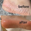 에이르네일 | 이수역 에이르네일 무좀발톱 발각질관리 솔직후기