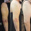 메디컬조의원 | [내돈내산] 팔/등 무한람스 -5cm 감소 솔직후기 완벽 정리