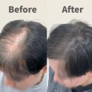 월드탑 | 두피염색 고민 끝! 자연스러운 남자 정수리탈모 커버