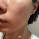 효자로 | 피부과 고주파 리프팅 모공 레이저 시술 디바이스 써마지 올타이트 튠페이스 후기