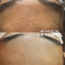노원 맨즈케어 남자 여드름 피부관리와 윤곽관리가 동시에 가능한 수디끌스킨