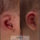 신생아 귀교정도 있네 이미지