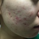 본한의원 | 모낭염 원인 한의원 시술로 효과 본 후기