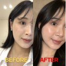 신사피부과 루스킨엑스 피부진단 후 리투오 스킨부스터 내돈내산 솔직후기 | 7일차 솔직변화까지!