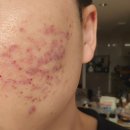 한창한의원 | 신사 피부과 한의원에서 받은 여드름 패인흉터 제거, 새살침 치료 남자 1회차 후기