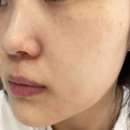 수복한의원 | [시술] 힐로웨이브 2cc + 셀르디엠 6cc 내돈내산 후기 | 눈밑 고랑·피부결 변화｜공장형 피부과 가격