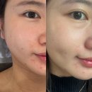 동안라인스킨케어 | [서울/강서]마곡문제성피부 전문 여드름케어 추천 '라인메이드스킨케어' 후기