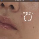 대한민국365한의원 | 쿼드쎄라 티탄(T1) 민감성 피부 내돈내산 1달 사용 후기