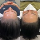6026 | 얇아진 모발 고민 인천탈모관리로 해결, 자연스러운 두피커버 찾는다면 혜지오 방문 후기