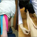 무릎 뒤쪽 부상의 치료·예방법 이미지