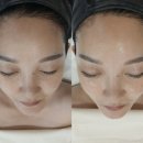 늘빛나에스테틱 | 포항에스테틱 빛나안에스테틱 5세대 닥토필 리얼후기 (전후사진, 동영상포함)
