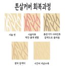 태성메디칼 | 튼살커버 후기 주블링&amp;스킨52에서 1회차 받고 왔어요 (사진 有)