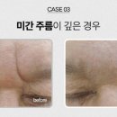 로데오피부과 티스토리