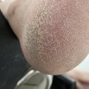 루덴풋케어닥터아이티엔 | 송파 몽촌토성 발각질 루덴풋케어에서 해결받고 지내는 행복한 나날들