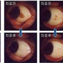 결막모반 제거 방법 (눈에 점, 눈 흰자 점, 레이저). 이미지