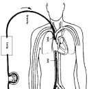 에크모(ECMO, Extracorporeal Membrane Oxygenation)란 이미지