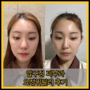 바늘요정 | 압구정역 피부과 요정 귀필러 후기 누운귀 개선 성공!
