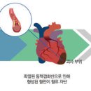 심근경색 전조증상 원인 치료 심근경색 골든타임 심근경색 좋은 음식 이미지