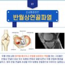 무릎뒤쪽 오금 아플때 통증 원인 이미지