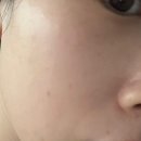 자연예쁨의원 | 건대입구피부과 | 예쁨주의쁨의원에서 필로드 후기 (1-5일차 경과)