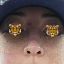 송정한의원 | 서울 강남 압구정 흑자성지에서 흑자,편사,비립종,점,주근깨 제거하고 온 개인적 후기