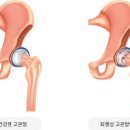 고관절 통증 원인 예방 조기진단 퇴행성 고관절염 이미지