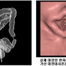 대장암-직장암의 진단 및 치료를 위한 영상의학과의 역할 이미지