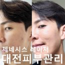 MAX(맥스) | 대전피부관리 여드름 색소 침착, 모공 효과 제네시스 레이저 후기.