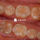 고호치과의원 | 신경과 가까운 하악 양쪽 매복치, 수지구청역 치과 당일 사랑니 발치