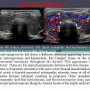 Graves disease 이미지